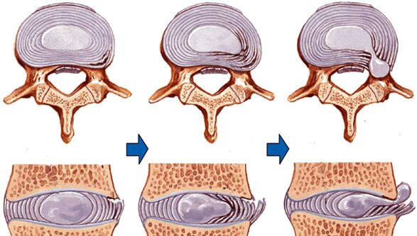 Spinal injury in osteochondrosis