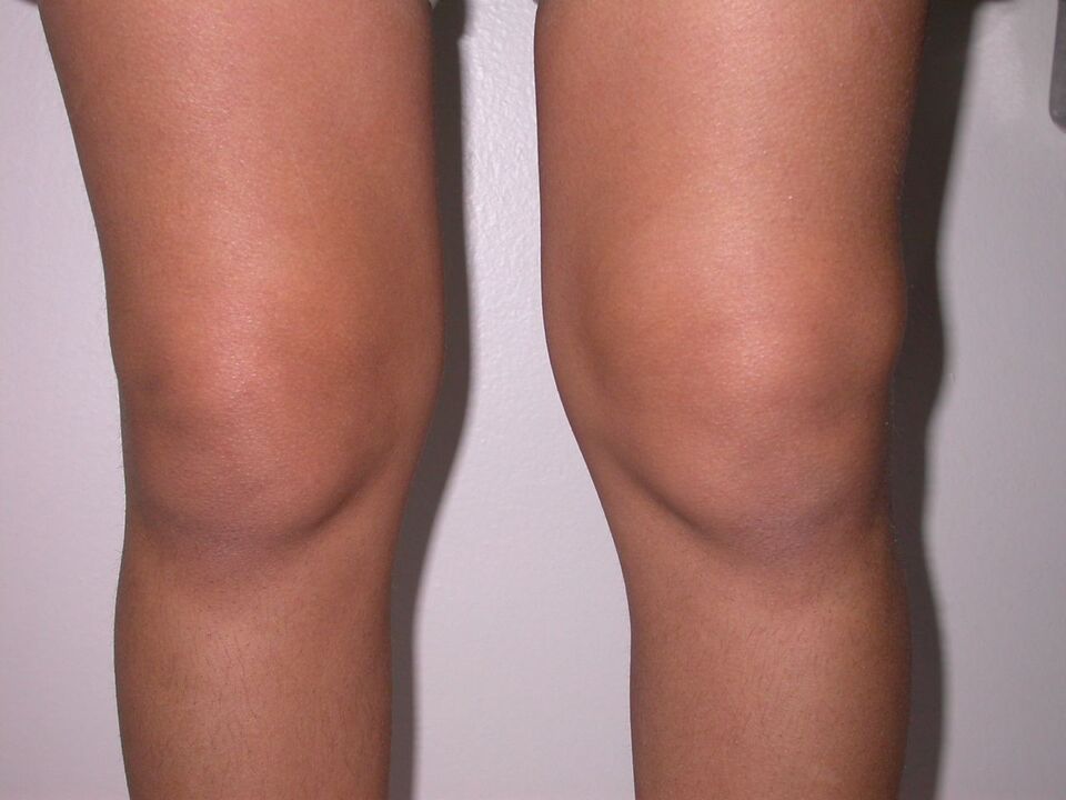 Knee swelling from osteoarthritis