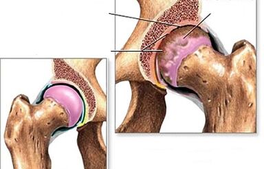Diagnosis of hip arthrosis