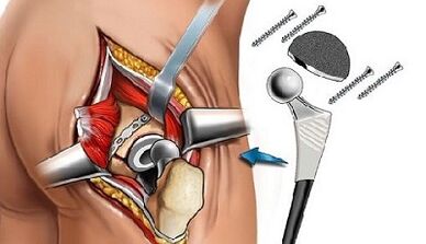 Endoprosthetics for hip star throats