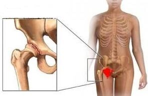 The reasons for the development of the arthrosis of the hip joint