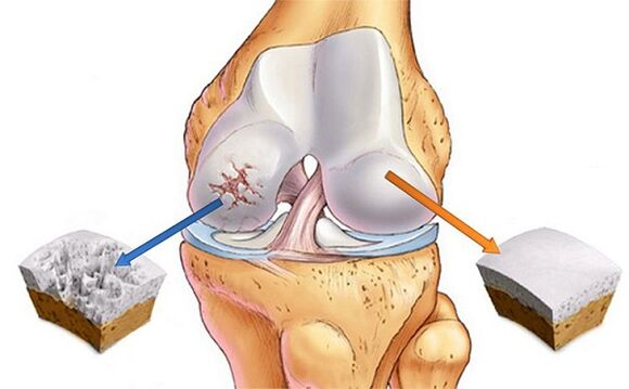 Norm and deviation to the arthrosis of the knee joint