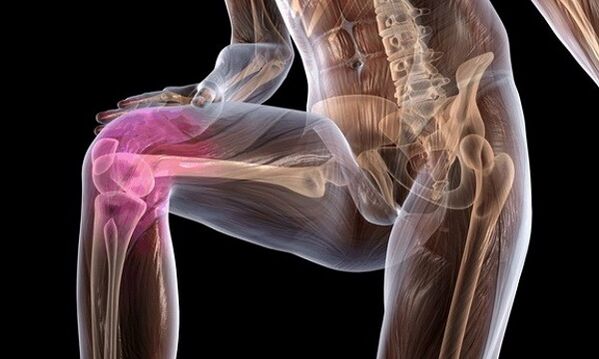 Signs and symptoms of osteoarthritis of the knee joint