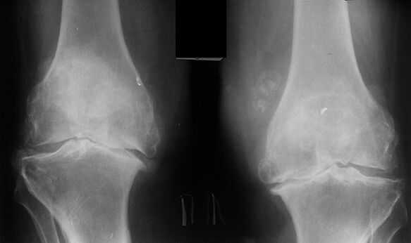 X -Ray as a means of diagnosing osteoarthritis of the knee joint