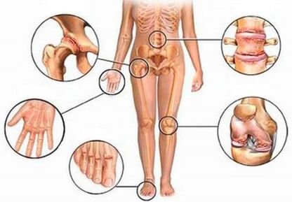 Arthritis and osteoarthritis of different joints