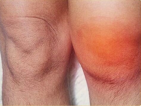 Inflammation of the knee joint affected by arthritis