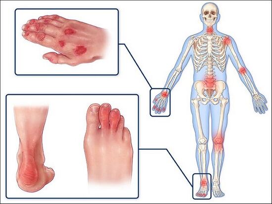 Reduction of skin and swelling of the joints with arthritis