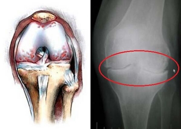 The deformation of the knee joint to arthrosis