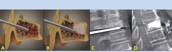 Puncture vertebroplasty for back pain