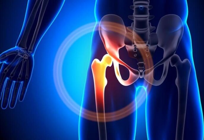 Hip pain