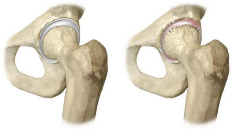 healthy hip joint and necrosis of the head as a cause of pain
