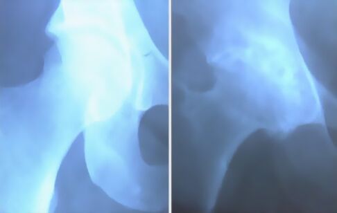 Image of osteoarthritis of the knee joint