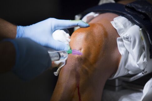 Injections into the knee joint for osteoarthritis