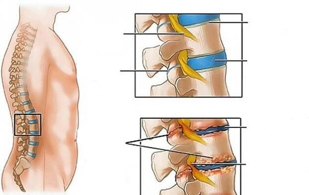 Lumbar spine osteochondrosis causes back pain