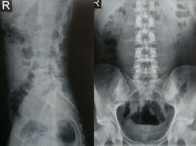 Lumbar spine x-ray