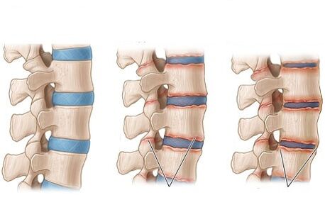 Stages of ankylosing spondylitis